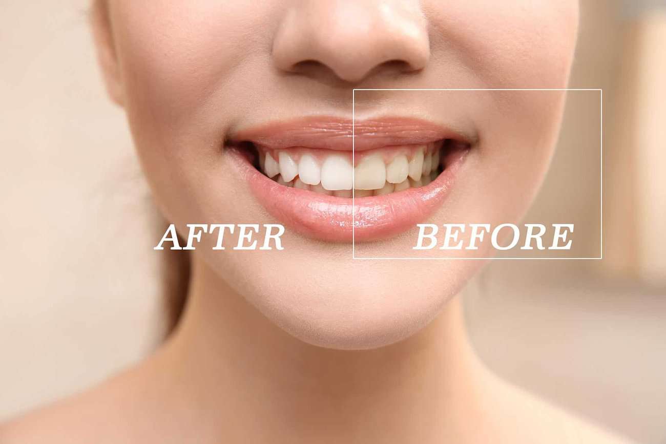 How Can You Maintain a Consistent Smile Shade with Crowns Woking?