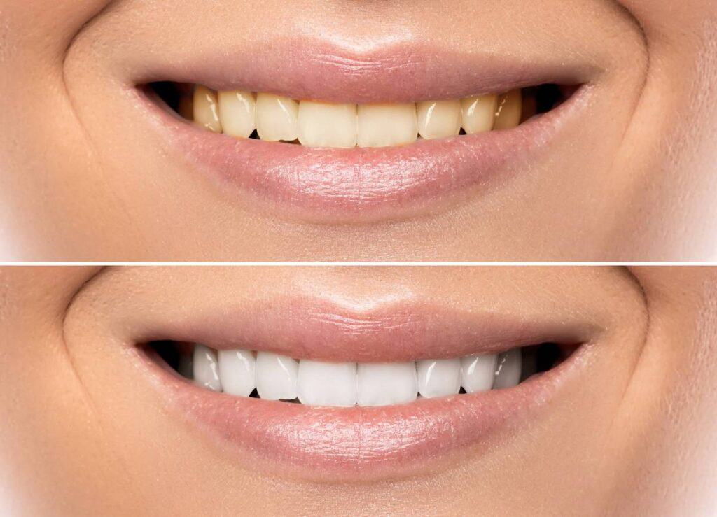 How Can You Protect Your White Smile as a Coffee Lover Woking?