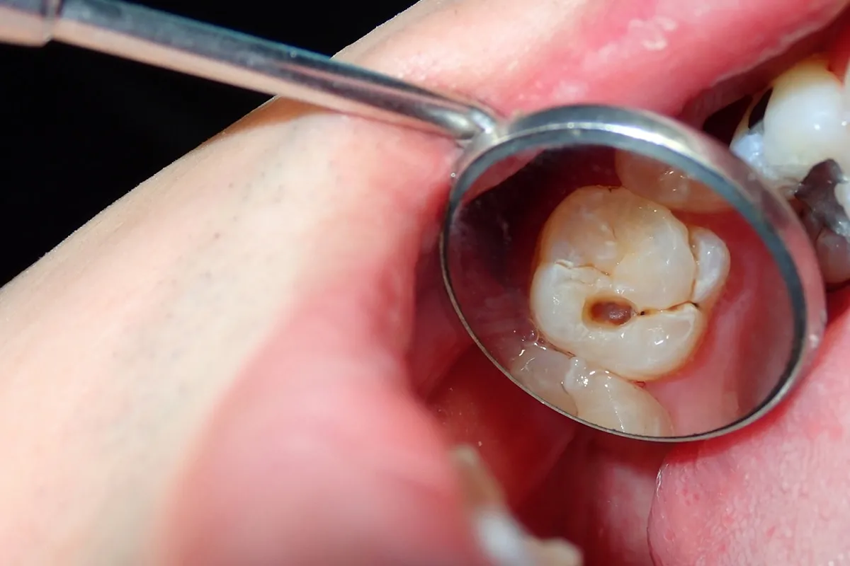 Why Do Teeth Crack? Common Causes to Know Woking