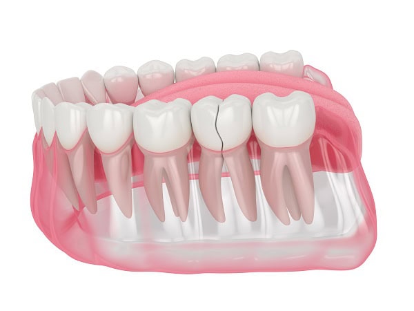 How Can You Manage Pain and Discomfort After a Root Canal Woking?