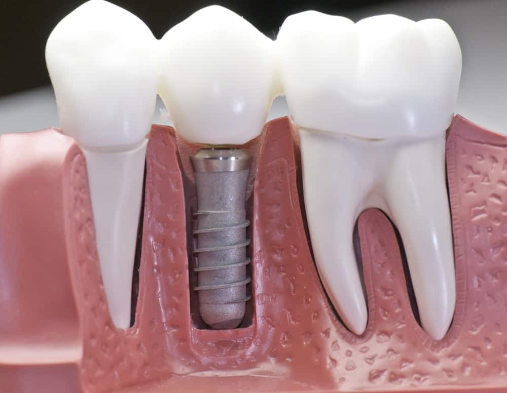 Common Misconceptions About Modern Dental Treatments Woking