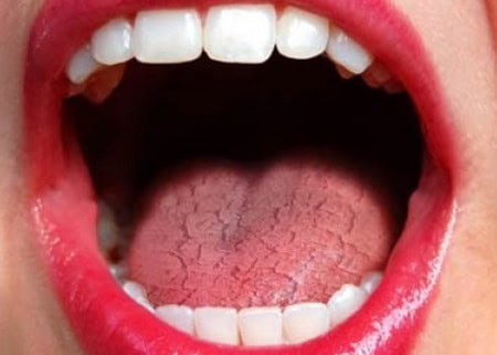 Dry Mouth and Its Role in Tooth Decay Woking