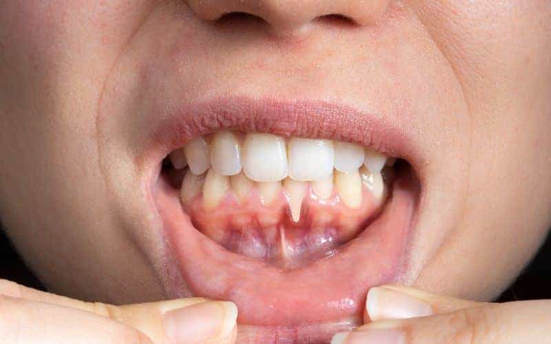 How Can Gum Disease Be Prevented Woking?