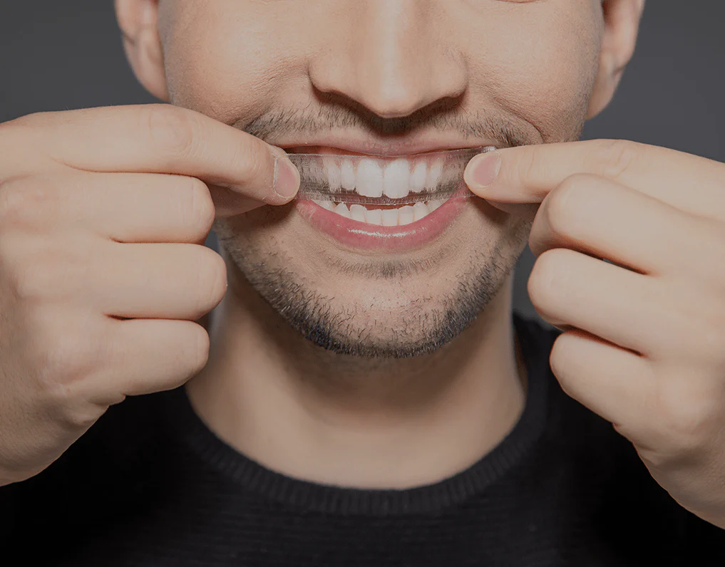 What to Consider Before Choosing a Teeth Whitening Option Woking