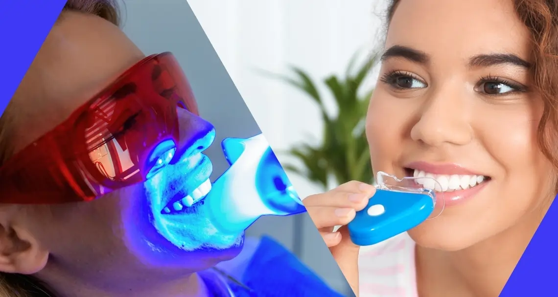 Impact of Home Kits {name} versus Professional Teeth Whitening Treatments