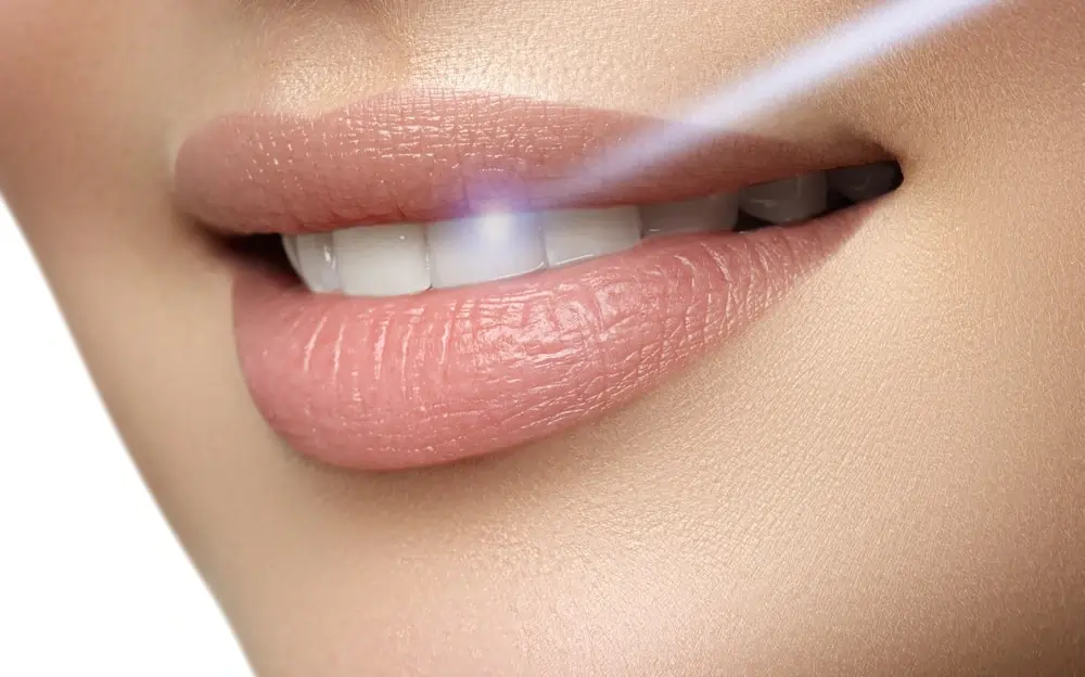 How Long Does Laser Teeth Whitening Last on Your Teeth Woking?