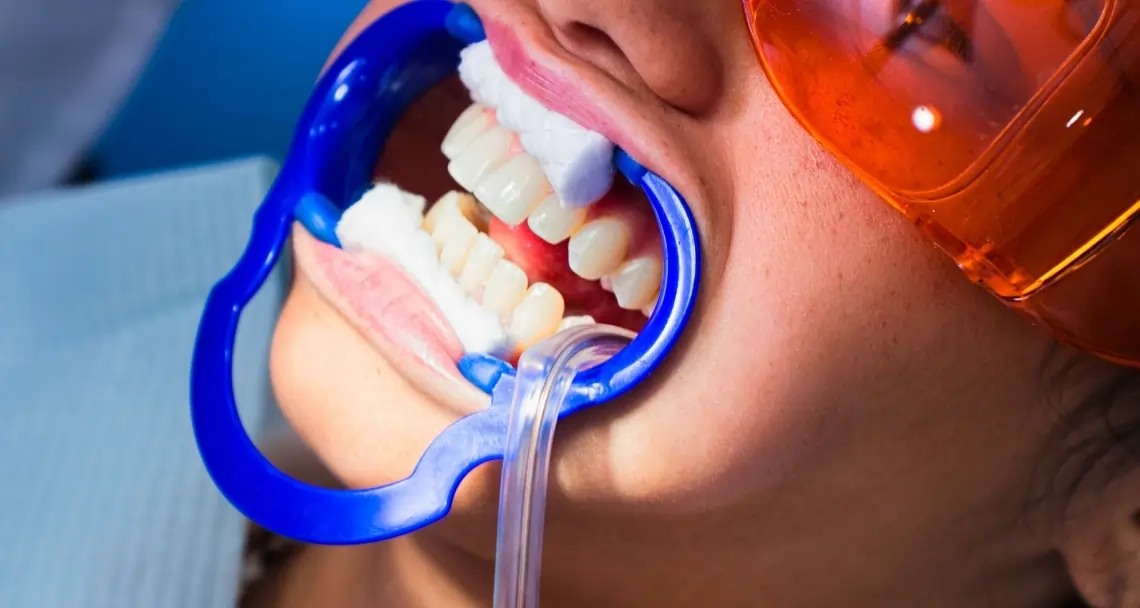 What Side Effects Can You Experience After Laser Teeth Whitening Woking?