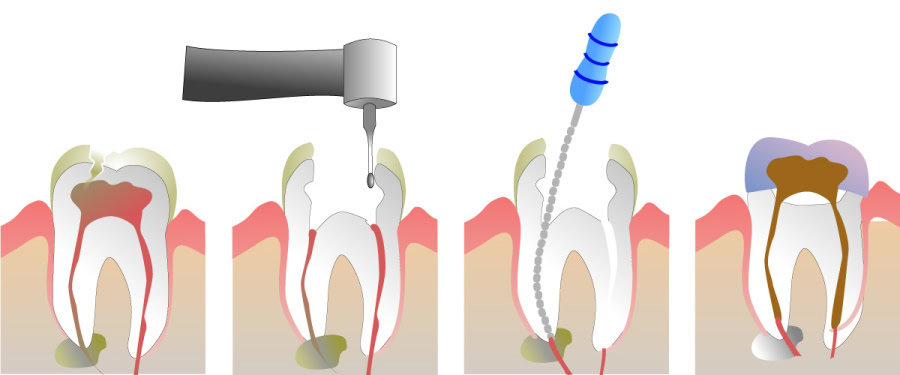 How Do You Properly Care for Your Teeth After a Root Canal Woking