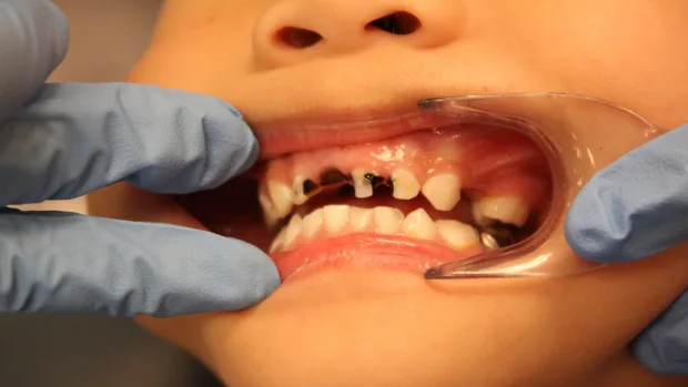 Tips for Keeping Your Child’s Baby Teeth Healthy and Strong Woking