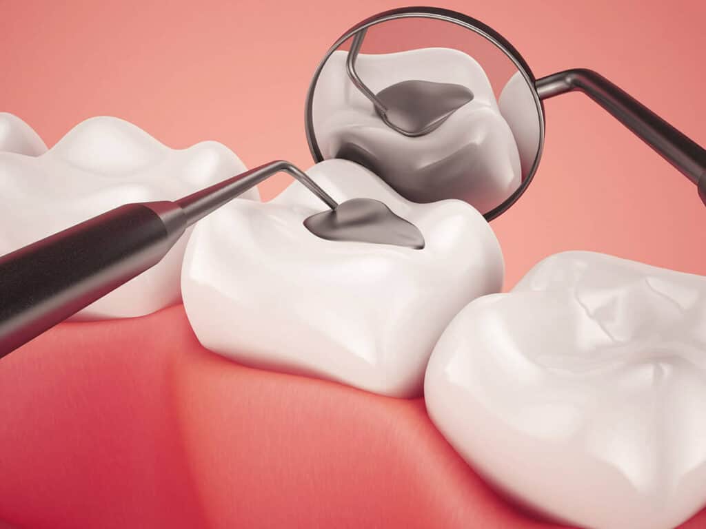 Fighting Cavities and Plaque Buildup Woking
