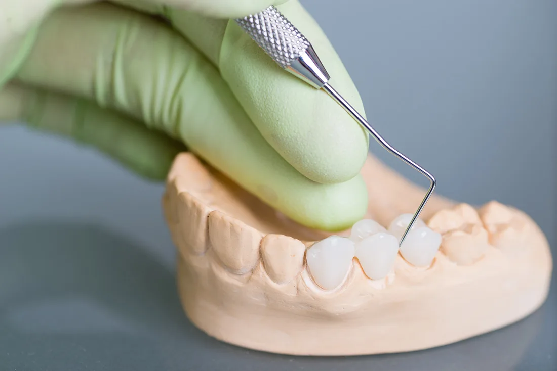What Are the Different Types of Dental Crowns Available Woking?