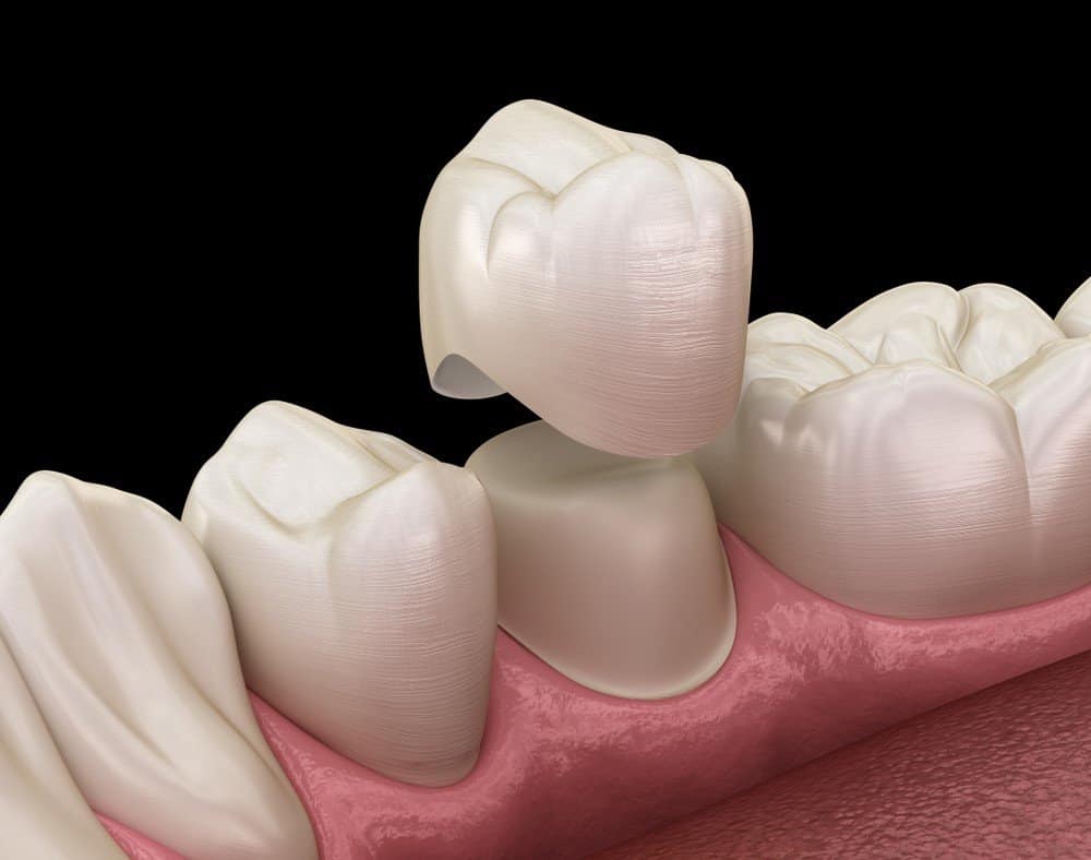 Teeth Whitening: Separating Facts from Fiction Woking