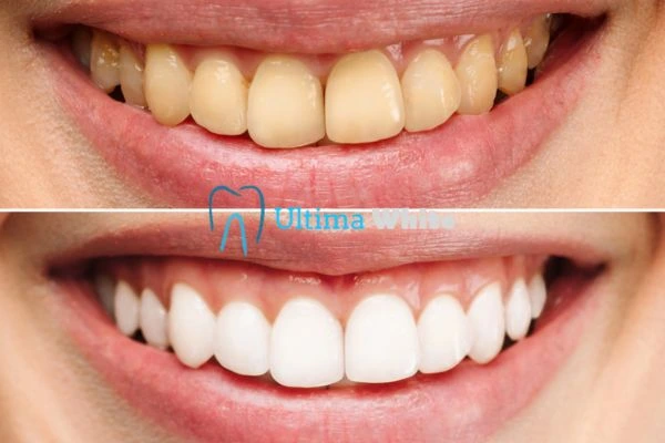 Oral Care Tips for Current and Former Smokers Woking