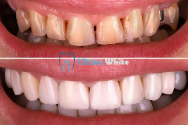 What Makes Instant Teeth Whitening Treatments So Popular Woking?
