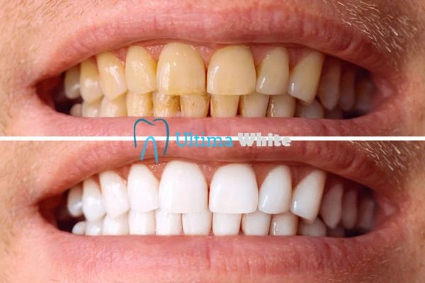 Stained Teeth and Persistent Bad Breath Woking